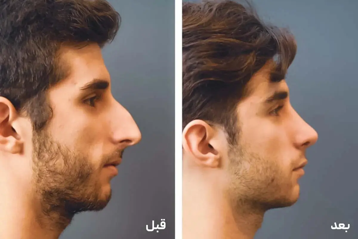 نمونه کار قبل و بعد عمل بینی پزشک 24
