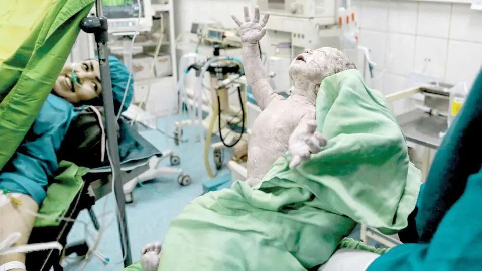 «سقوط» زایمان