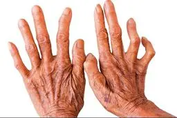 90 تا ۹۵ درصد هرگز جذام نمی‌گیرند
