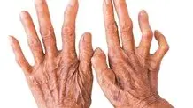 90 تا ۹۵ درصد هرگز جذام نمی‌گیرند

