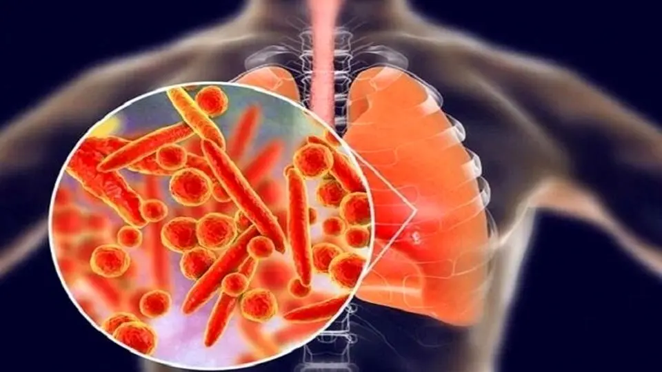 هشدار درباره بیماری انسدادی مزمن ریه