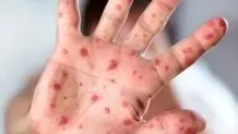 خطر افزایش بروز سرخک در کشور 
