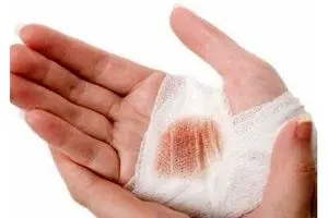 امن‌ترین راه برای خروج ترکش‌ها و تلاش برای تثبیتِ آن‌ها