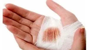 امن‌ترین راه برای خروج ترکش‌ها و تلاش برای تثبیتِ آن‌ها