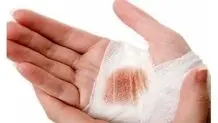 امن‌ترین راه برای خروج ترکش‌ها و تلاش برای تثبیتِ آن‌ها