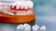 قیمت لمینت دندان با تخفیف از بهترین ارائه دهندگان در دکترتو کلینیک