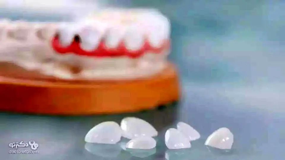 قیمت لمینت دندان با تخفیف از بهترین ارائه دهندگان در دکترتو کلینیک
