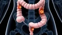 ترشی پرخاصیت طبیعت؛ گوجه‌سبز، دشمن سموم و دوست قلب