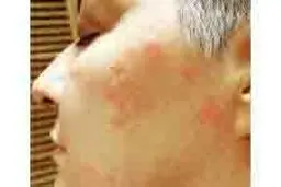اضطراب و آلودگی باعث عود بیماری‌های پوستی من شد
