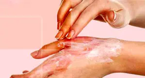 پانسمان‌های نوین سوختگی بیمه شد

