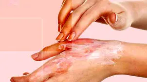 پانسمان‌های نوین سوختگی بیمه شد

