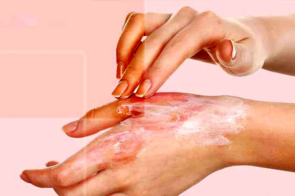 پانسمان‌های نوین سوختگی بیمه شد

