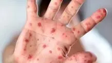 زنگ خطر شیوع بیماری کشنده در یزد