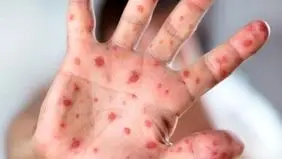 زنگ خطر شیوع بیماری کشنده در یزد