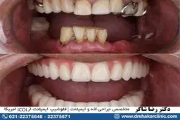 همه چیز درباره اوردنچر متکی بر ایمپلنت

