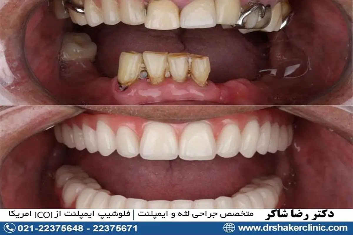 همه چیز درباره اوردنچر متکی بر ایمپلنت

