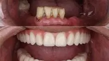 همه چیز درباره اوردنچر متکی بر ایمپلنت

