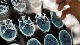 هشدار جدی: شروع خاموش آلزایمر از دهه چهارم زندگی