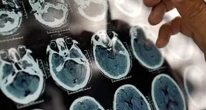 هشدار جدی: شروع خاموش آلزایمر از دهه چهارم زندگی