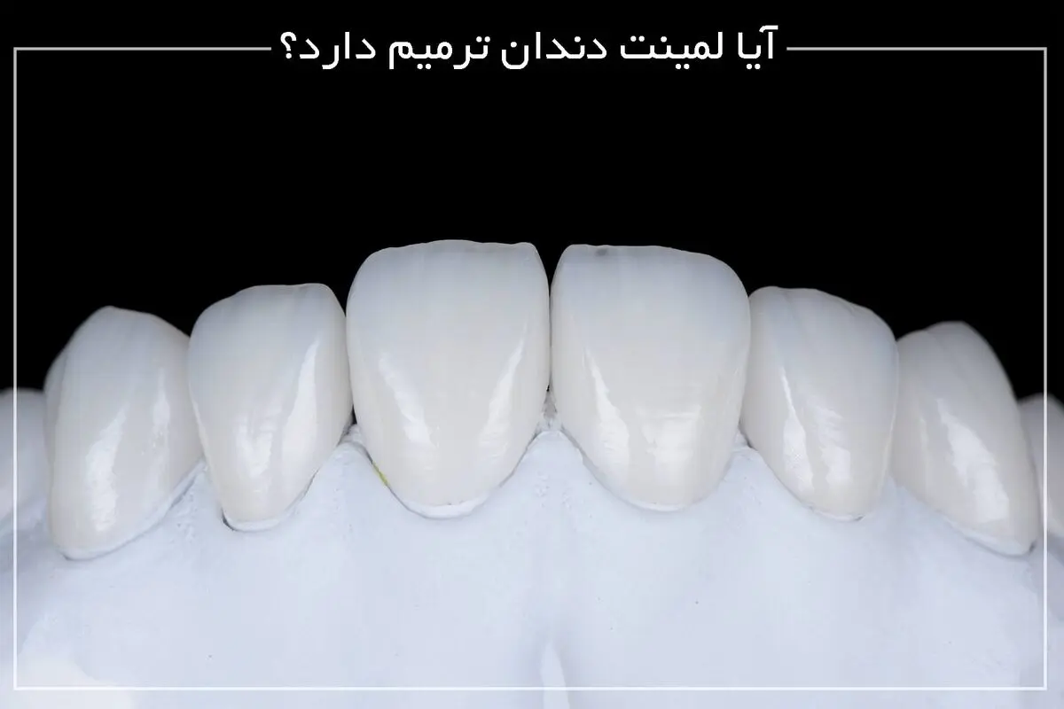 آیا لمینت دندان ترمیم دارد؟