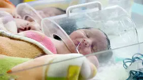 افزایش تولد نوزادان با اختلالات کروموزومی