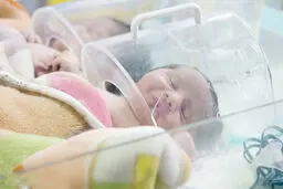 افزایش تولد نوزادان با اختلالات کروموزومی