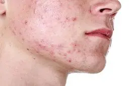  استراتژی‌های کارآمد برای کمک به نوجوانان در مواجهه با مشکلات هورمونی

