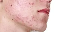  استراتژی‌های کارآمد برای کمک به نوجوانان در مواجهه با مشکلات هورمونی

