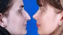 جراحی بینی امسال چند درمی‌آید؟