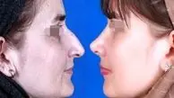 جراحی بینی امسال چند درمی‌آید؟