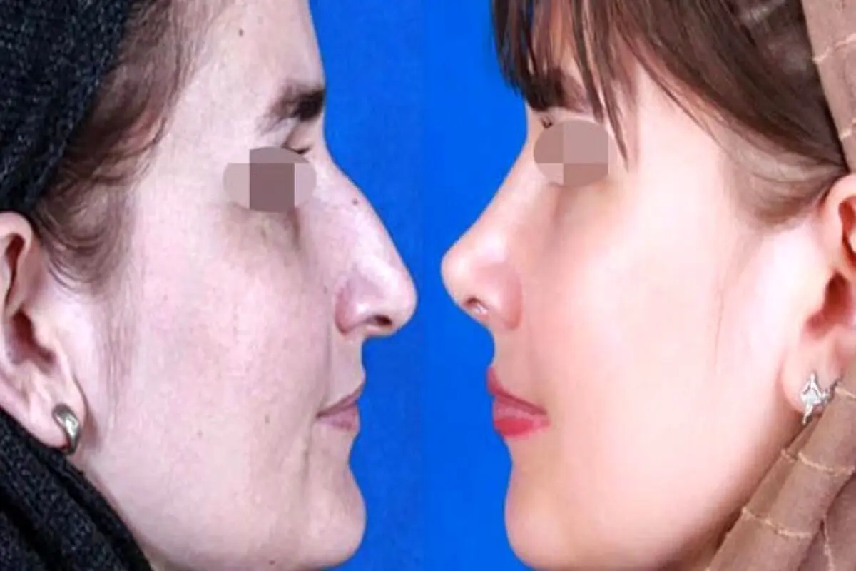 جراحی بینی امسال چند درمی‌آید؟