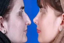 جراحی بینی امسال چند درمی‌آید؟