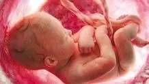 وزارت بهداشت خبر تولد ۱۲ نوزاد با سندروم داون را تکذیب کرد

