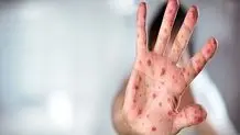 شناسایی ۶۷۴ ابتلا به سرخک

