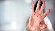شناسایی ۶۷۴ ابتلا به سرخک در سال گذشته