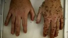 راهکارهای طلایی برای جلوگیری از گزش پشه‌ها
