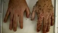 راهکارهای طلایی برای جلوگیری از گزش پشه‌ها