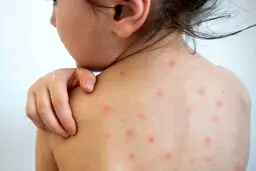 تأکید وزارت بهداشت بر  واکسیناسیون سرخک در استان‌های غربی و شرقی