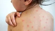 تأکید وزارت بهداشت بر  واکسیناسیون سرخک در استان‌های غربی و شرقی