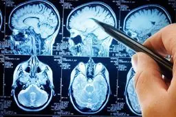 پیشگیری آسان از سکته مغزی با چند نکته کلیدی