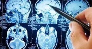 پیشگیری آسان از سکته مغزی با چند نکته کلیدی