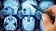 پیشگیری آسان از سکته مغزی با چند نکته کلیدی