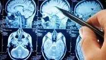 پیشگیری آسان از سکته مغزی با چند نکته کلیدی