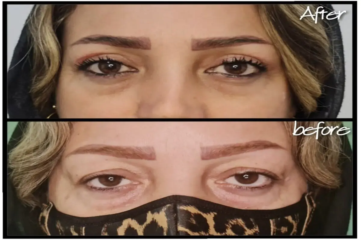 بهترین سن برای عمل بلفاروپلاستی، سن ایده آل بلفارو را بدانید!

