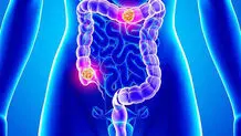 پستان، دهانه رحم و روده بزرگ؛ شایع‌ترین سرطان‌ها

