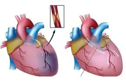 سکته قلبی از کودکی آغاز می‌شود، نه از میانسالی