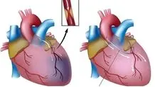سکته قلبی از کودکی آغاز می‌شود، نه از میانسالی