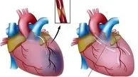 سکته قلبی از کودکی آغاز می‌شود، نه از میانسالی