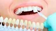 آیا کامپوزیت باعث پوسیدگی دندان میشود؟