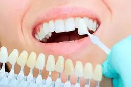 آیا کامپوزیت باعث پوسیدگی دندان میشود؟